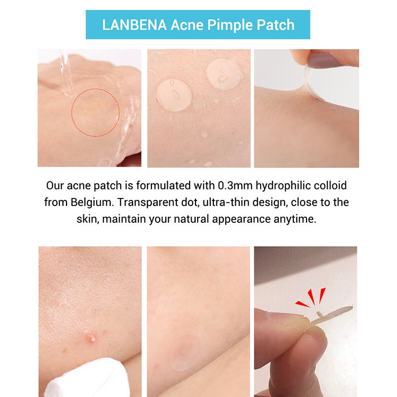 Acne stickers, fade, acne marks